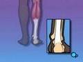 PreOp® Patient Education Orthopedic: Achilles Tendon Repair