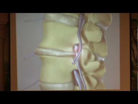 how to treat spinal stenosis