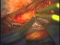 Access To The Cranium Middle Fossa - Part 2 Access To The Cranium Middle Fossa - Part 2