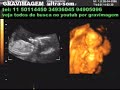 GRAVIMAGEM 105 (ULTRA-SOM GESTAÇÃO 3D 4D 17 SEMANAS) GRAVIMAGEM 105 (ULTRA-SOM GESTAÇÃO 3D 4D 17 SEMANAS)