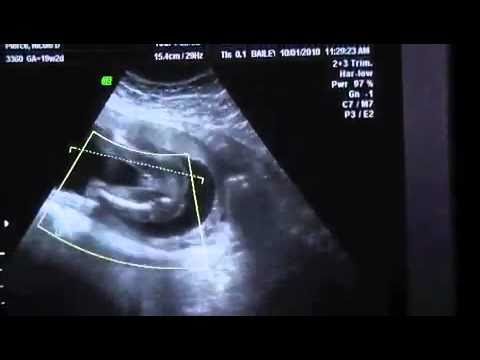 4D Ultrasound 20 Weeks finding out gender