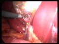 No-scar gallbladder removal. Single incision laparoscopic cholecystectomy. Marionette -style
