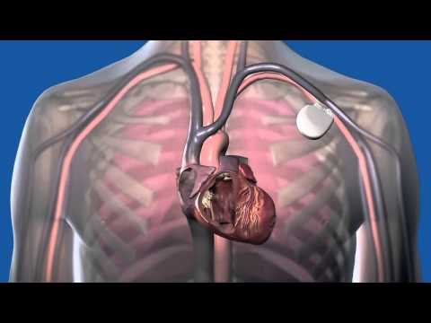 What Is a Defibrillator How Does It Work