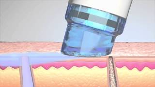 HydraFacial; The All In One Facial