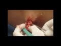 Sebaceous Cyst (Abscess) Sac Removal