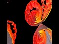 3D Fractal Explorer - Tricomplex Julia - Fire - Project 3