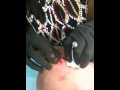 Digging out the Cyst