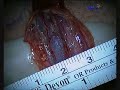 bilateral varicocele ligation surgery recovery