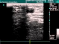 Lower Extremity Venous Thrombosis In Ultrasound Exam Lower Extremity Venous Thrombosis In Ultrasound Exam
