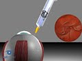 Scleral Buckling: Injection Of Gas VR1 Basic Techniques