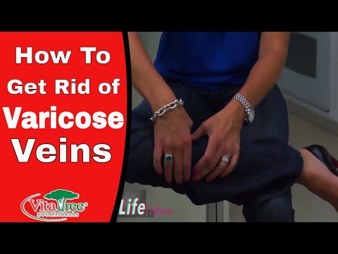 how to get rid veins on feet