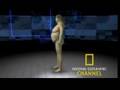 NGC Special on Obesity-Cushing's Segment