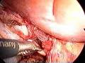 single port access cholecystectomy