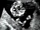 Ultrasound video 12 weeks June 10 (2)