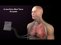 Passy-Muir Valve with Mechanical Ventilation