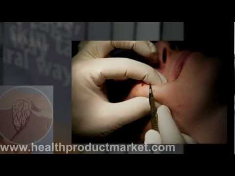 how to remove a skin tag with compound w