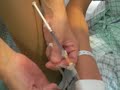 Alvin-s-IV-catheter-