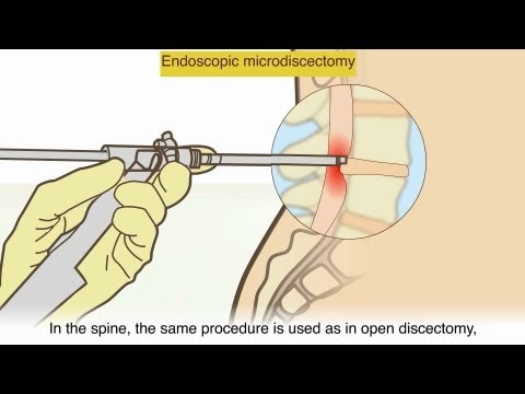 how to treat hnp