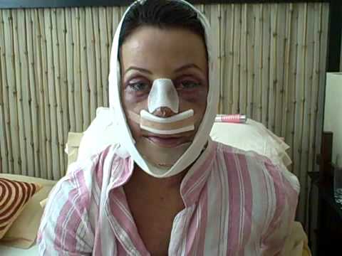 My Facial Plastic Surgery Blog - Recovery Day 2