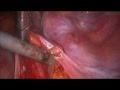 Laparoscopic Trachelectomy