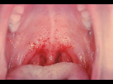 how to treat of strep throat