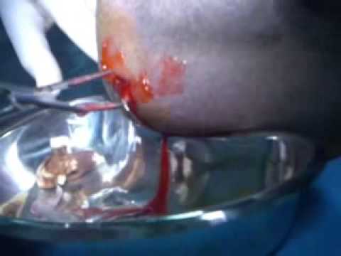 how to drain submandibular abscess