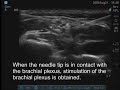 Ultrasound-Guided Interscalene Brachial Plexus Block