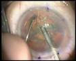 Richard Packard's cataract surgery with Zeiss Lumera