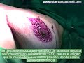 Paciente que presenta una hipertrofia mamaria severa, a la cual se le realiza una reducción y elevación de la misma, se marca la piel con  la técnica de Strombeck, llevando el complejo areola-pezón con un monopedículo interno, previos estudios mamográficos y ecográficos. Mastoplastías
