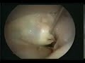 Thoracoscopic Mitral Valve Repair in Dilated Cardiomyopathy Cardiomyopathy
