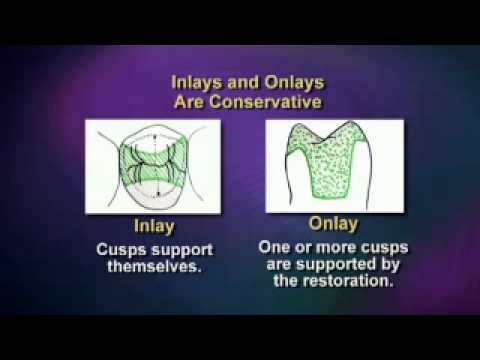 See how to place dental inlays and onlays with predictable success
