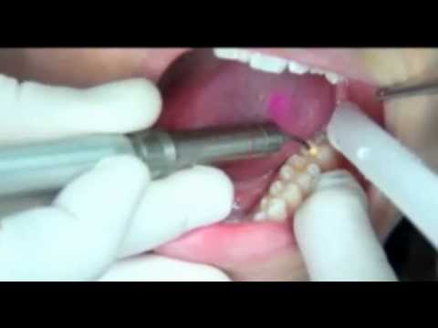 how to repair cavities