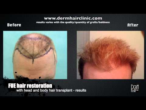how to repair hair follicles