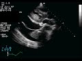 Large Pericardial Effusion