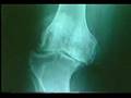 Arthritis by Dr Artherton and on forever freedom.