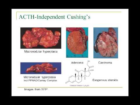 how to treat cushing's disease