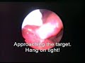 Interesting Foreign Bodies in the Throat