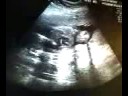Ultrasound of Heart
