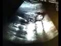Ultrasound of Heart