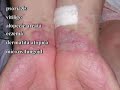Fototerapie (UVA si UVB banda ingusta) - pentru vitiligo, psoriazis, atopie, eczeme, alopecie areata