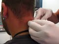Nape surface piercing, performed at urban piercings. A 14 gauge canula is used, with 1.6mm P.T.F.E inserted into the piercing.