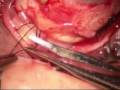 Retinal Detachment Repair with Macular Hole