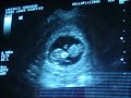 My 11 Week 4 Days Ultrasound
