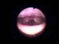 Functional Voice Disorder Functional Voice Disorder