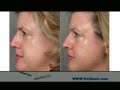 Thermage - innovate technology - facelift