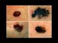 Moles And Warts cures and home remedies