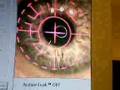 LASIK Eye Surgery