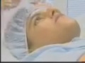Acne Laser Treatment Houston Texas Dr. Paul M. Friedman