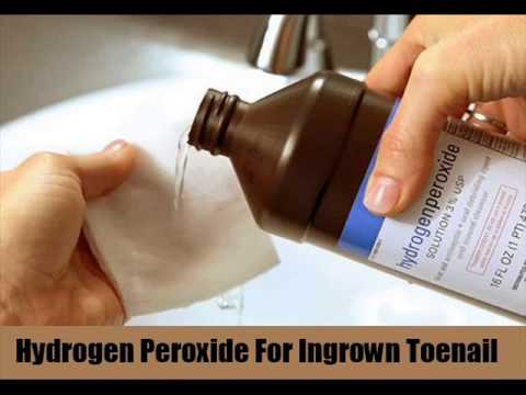 how to fix ingrown toenail
