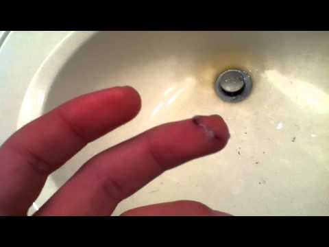 how to treat knife cut on finger